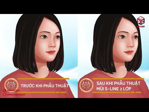 THẢO NGỌC SPA - NÂNG MŨI CẤU TRÚC SLINE